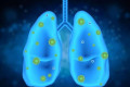 新型冠状病毒对肺癌患者的影响(新型冠状病毒可以治疗肺癌吗)