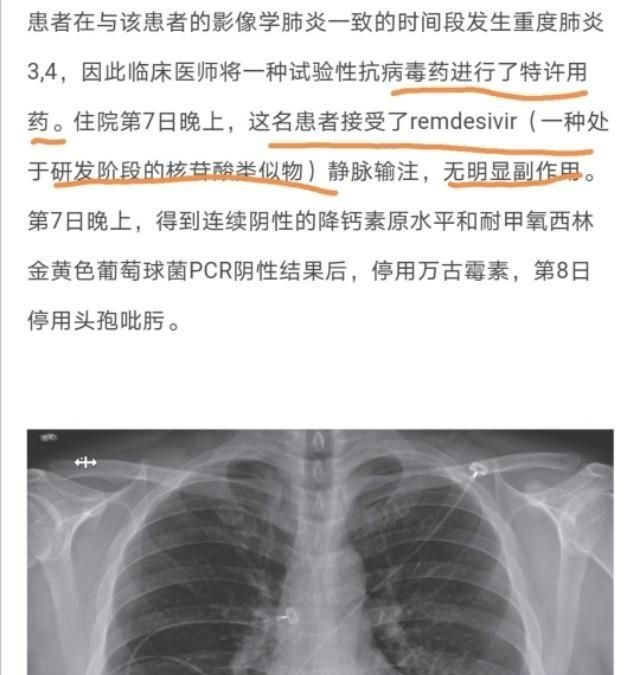 瑞德西韦治疗了几个患者图3