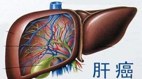 家人得了肝癌晚期怎么办图 1